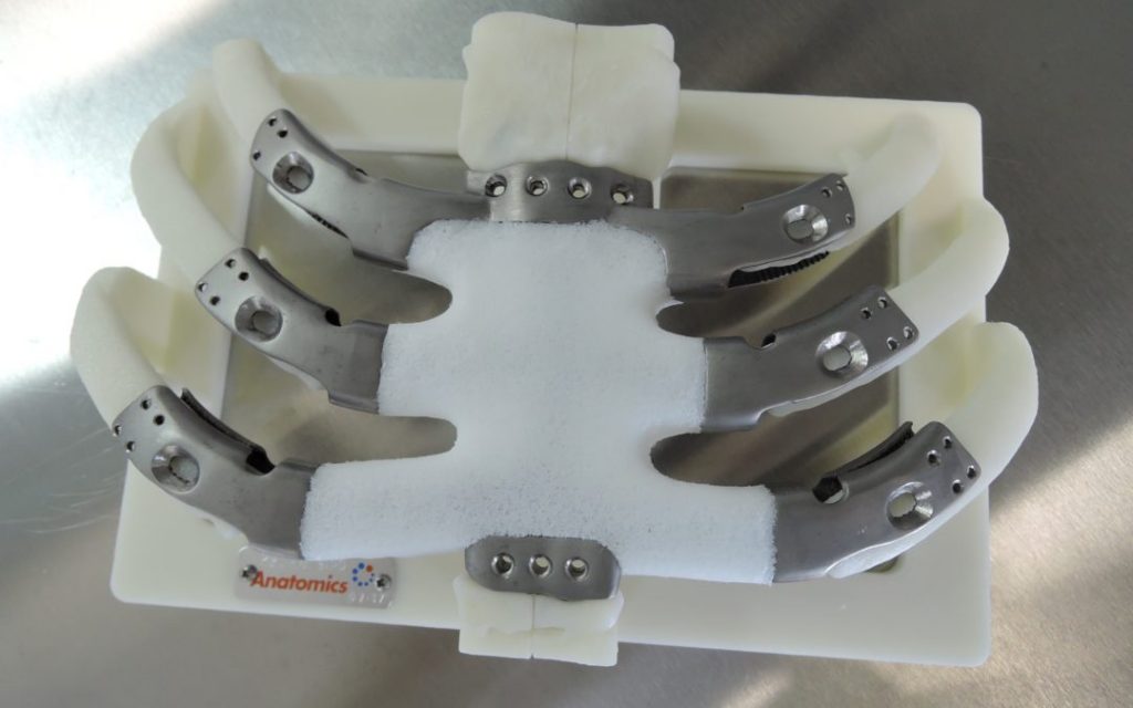 The 3D printed sternum section consists of both titanium and PoreStar. Photo via CSIO.