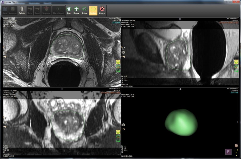 An isolated tumor (in green) from a 3D prostate scan. Image via Royal Philips