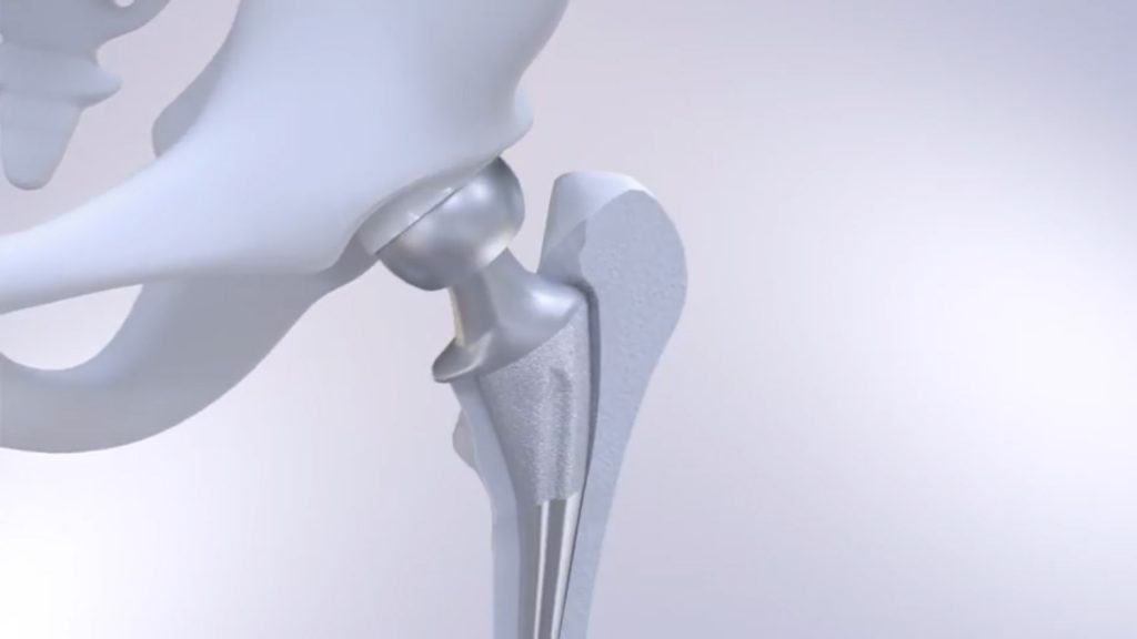 Graphic representaional of a traditional hip implant with space (on the right) to trap particles and create wear. Image via Tu Delft on YouTUbe