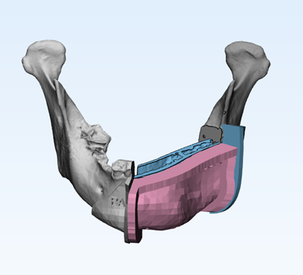 Planning the reconstruction of a jaw with 3D printing implants and bone grafts. Image via Oliver Burley