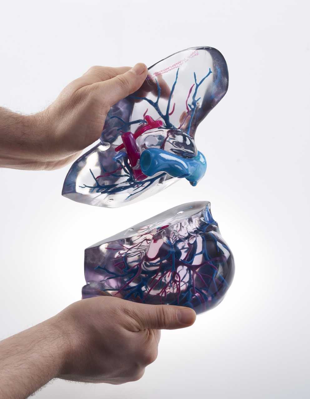 A 3D Printed medical model created with IntelliSpace Portal's built in 3D modeling application. Photo via Phillips.