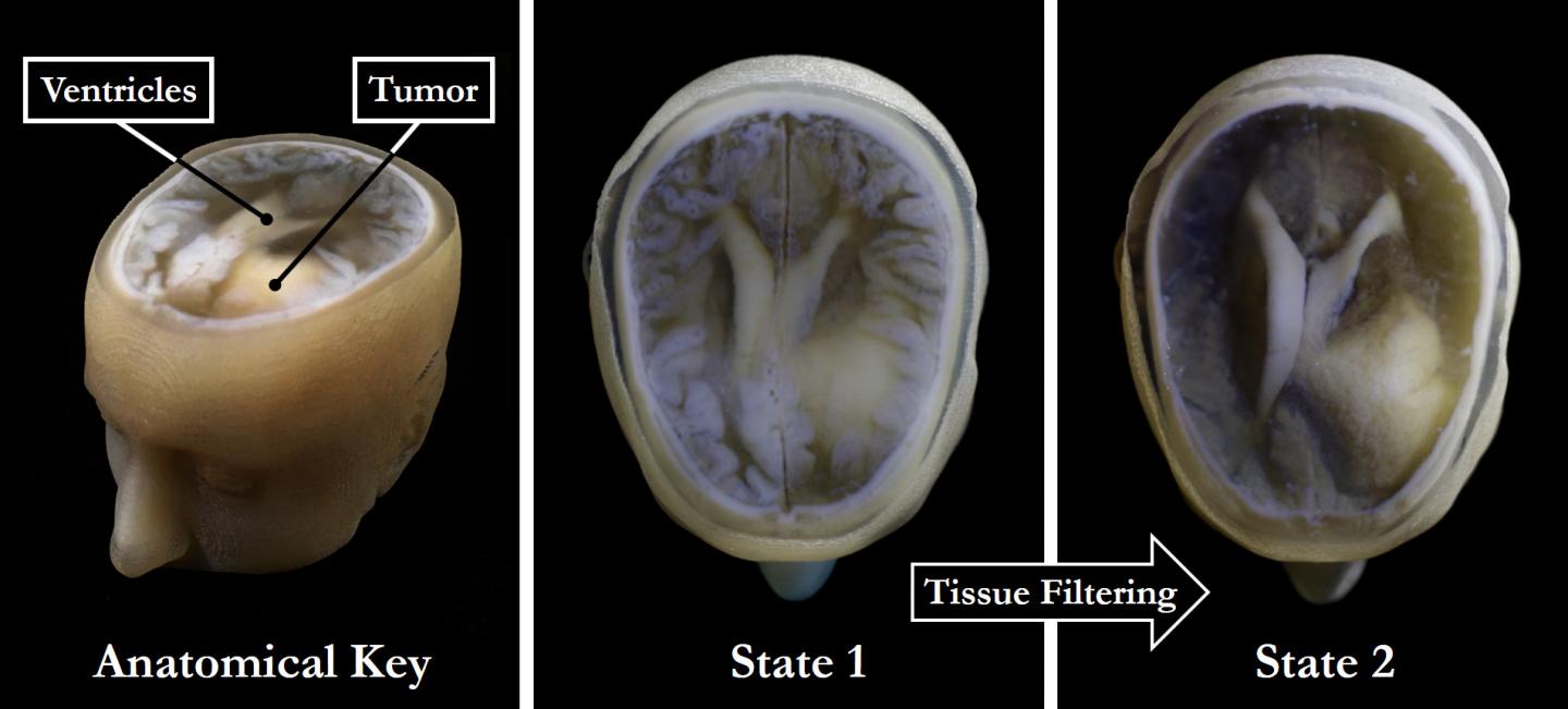 Annotated, 3D printed model of brain tumor using MIT/Harvard pixel processing. Image via Wyss Institute at Harvard University
