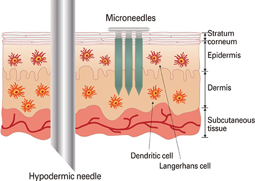 Insertion of a hypodermic needle vs. microneedle array. Image via Clinical and Experimental Vaccine Research 2014/Korean Vaccine Society.