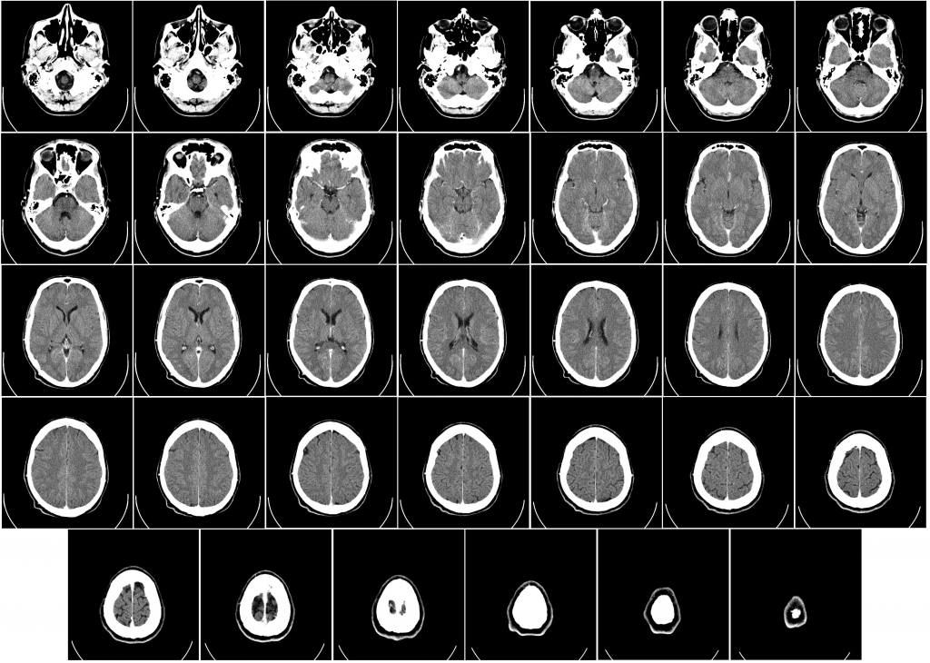 Unrelated CT scan imagery of a human brain. Image via Mikael Häggström/Department of Radiology, Uppsala University Hospital.