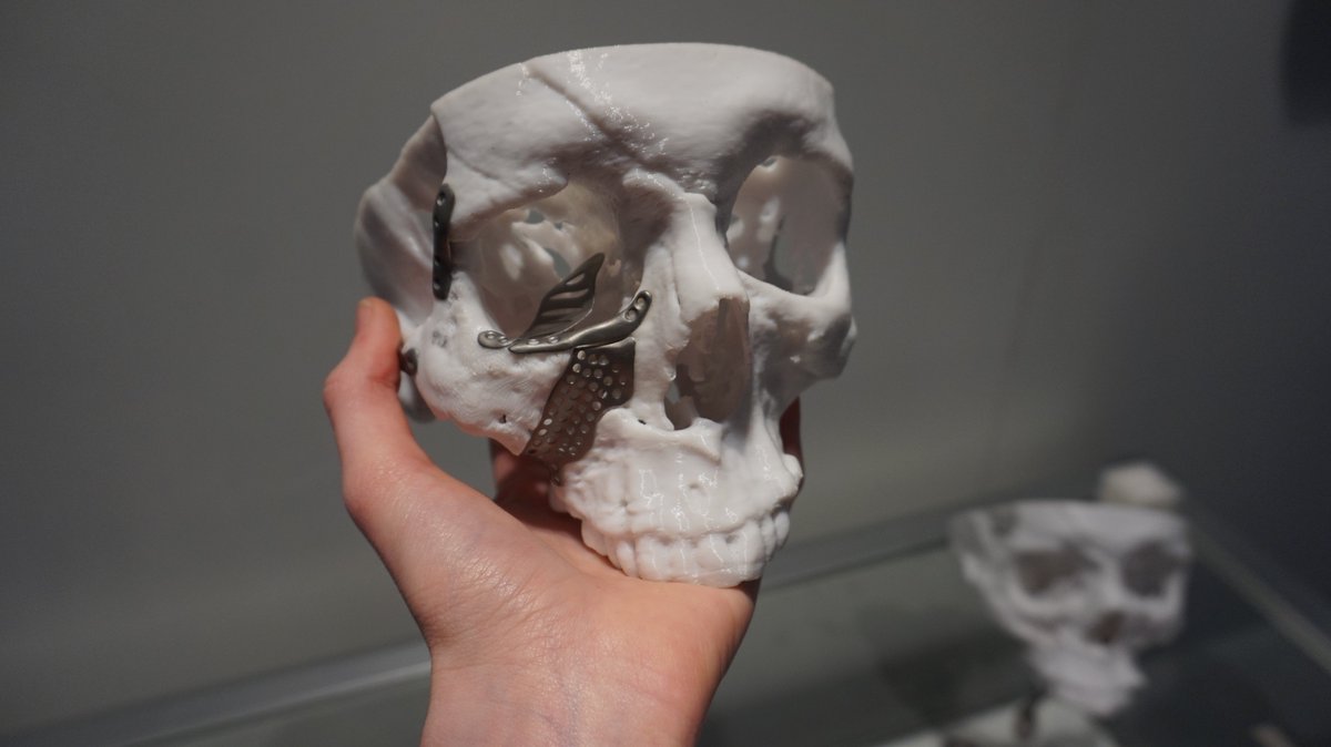 To 3D, or not to 3D? That is the question. 3D printed skull and implants by Renishaw. Photo by Beau Jackson