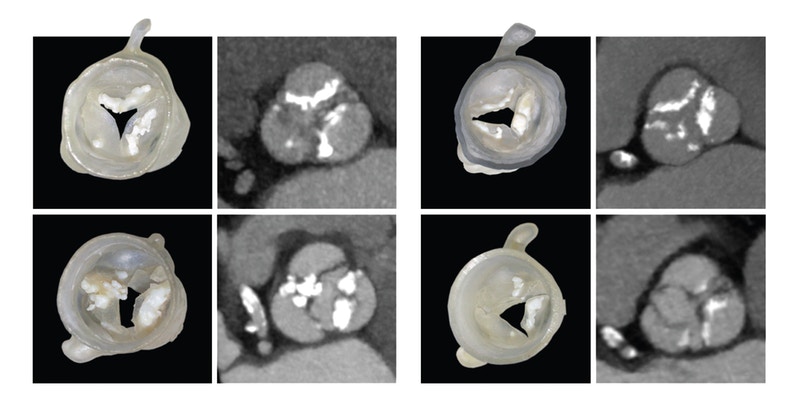 "3D printed models of four patients’ unique aortic valves are shown next to the CT scans from which they were created (calcified deposits are shown in white)." Image and caption via Wyss Institute at Harvard University