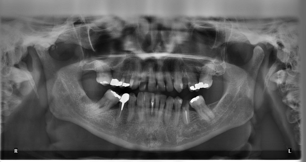 With x-rays orthodontists can spot a number of potential conditions in patients, and take this into consideration when fitting a brace. Dental x-ray image via deverton9 on Pixabay