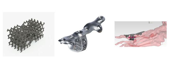 From left to right: Additive Orthopaedics’s lattice structure, plate / wedge orthopaedic device, and diagram of installment in the foot to combat a toe fracture. Images from Additive Orthopaedics.