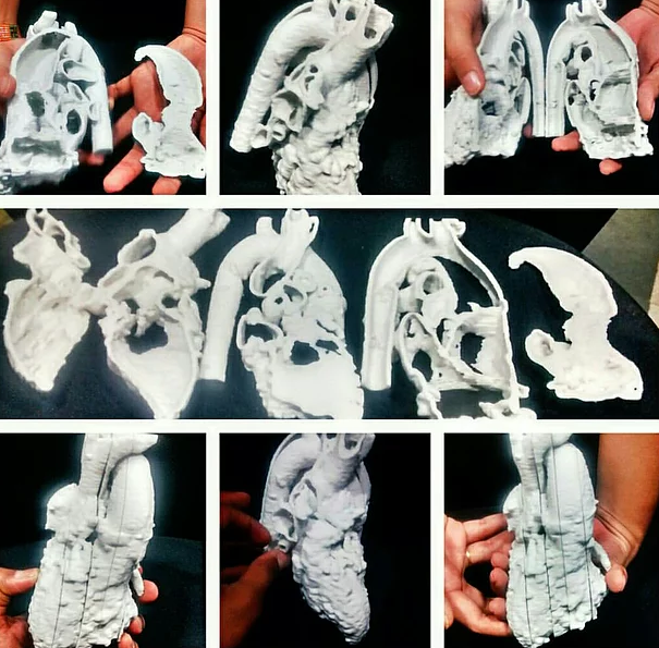 An 11 year old infant’s 3D printed heart model created by Anatomiz3D. Photo via Anatomiz3D.
