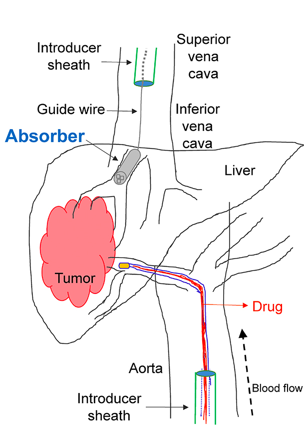Proposed placement of the ChemoFilter. Image via UC Berkeley