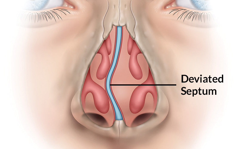 A graphic depicting deviated nasal septum. Image via St. Louis Sinus Center.