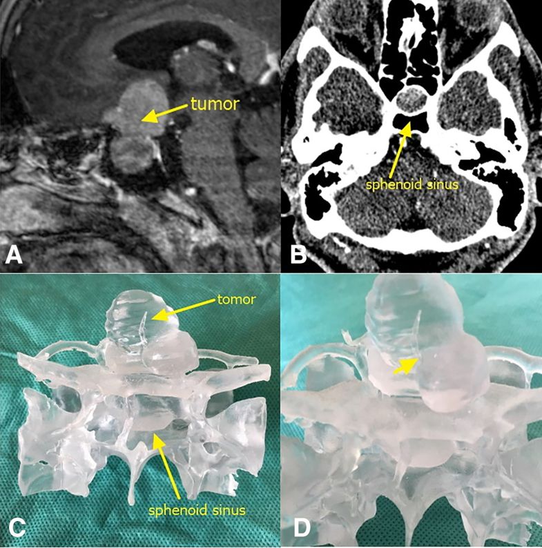 A) An tumor lesions. The yellow arrow points to the tumor itself. b) A CT of the sphenoidal sinus. c) A frontal view of the 3D printed tumor model. d) An enlarged image of a part of the tumor. The yellow arrow shows that the tumor wraps around the left side of the anterior communicating artery. Image via HUST.