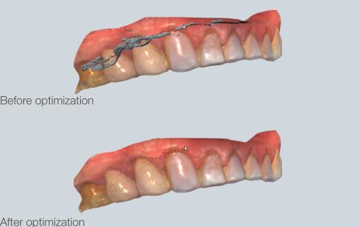 A intraoral scan is optimised using the Aoralscan 3D scanner software. Image via SHINING 3D.