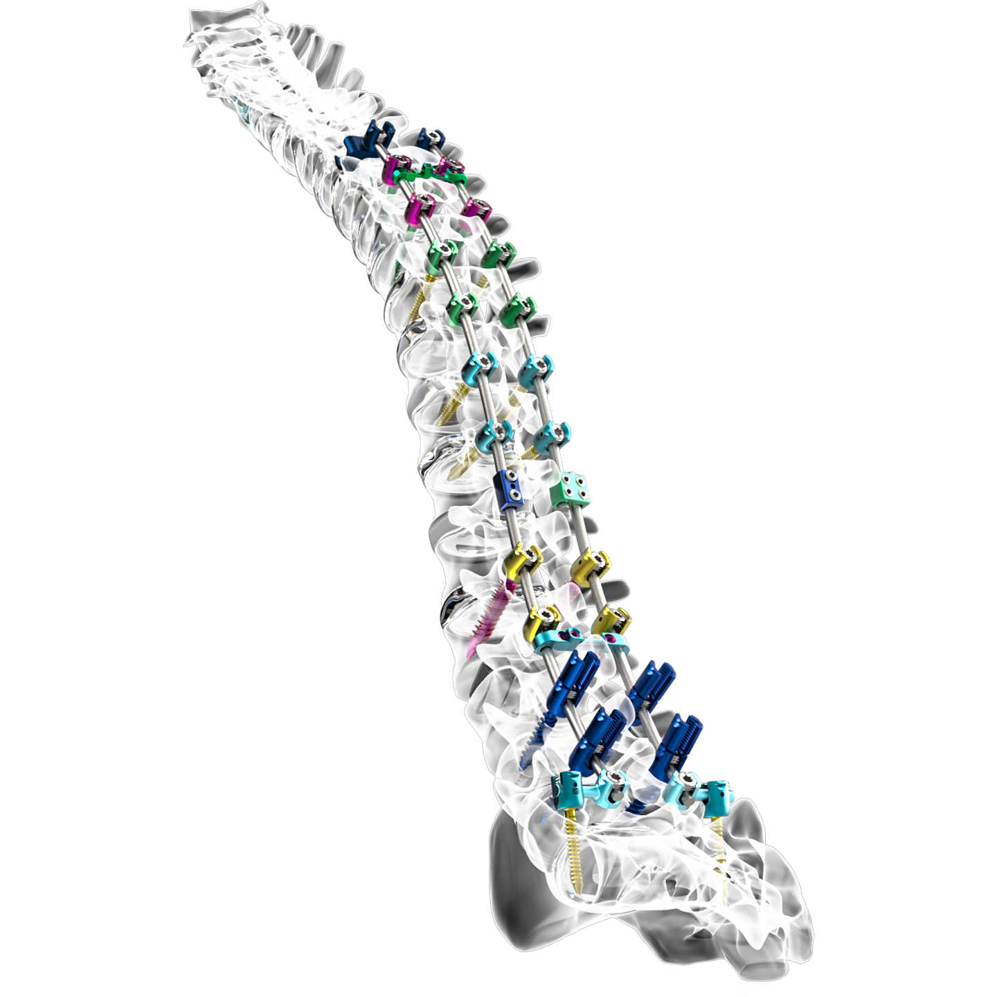 Inertia, a deformity correction system by Nexxt Spine. Image via Nexxt Spine.