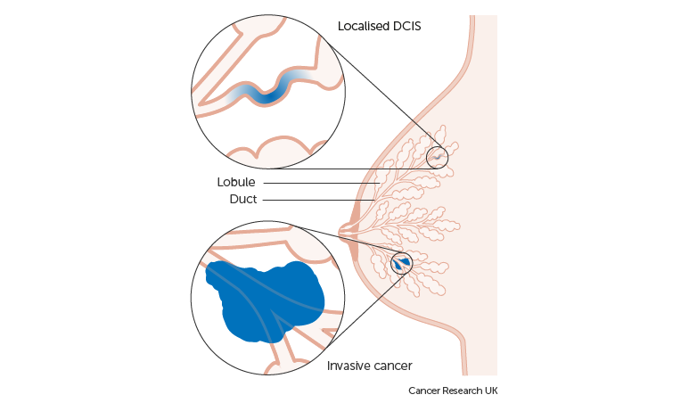 The occurrence of abnormal cells in ductal carcinoma in situ (DCIS) Image via Cancer Research UK