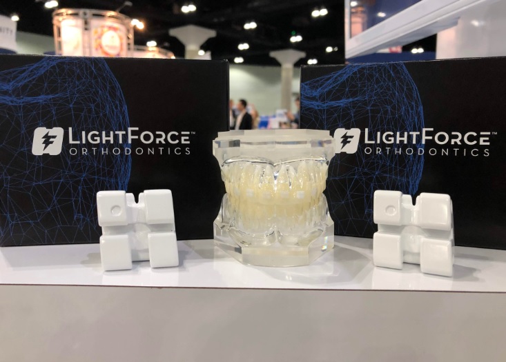 3D printed braces from LightForce Orthodontics. Photo via LightForce Orthodontics. 3D printed braces from LightForce Orthodontics. Photo via LightForce Orthodontics.