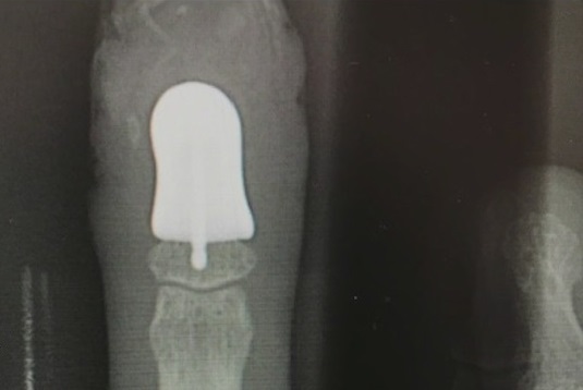 An X-ray of the 3D printed finger implant. Image via Fox 13.