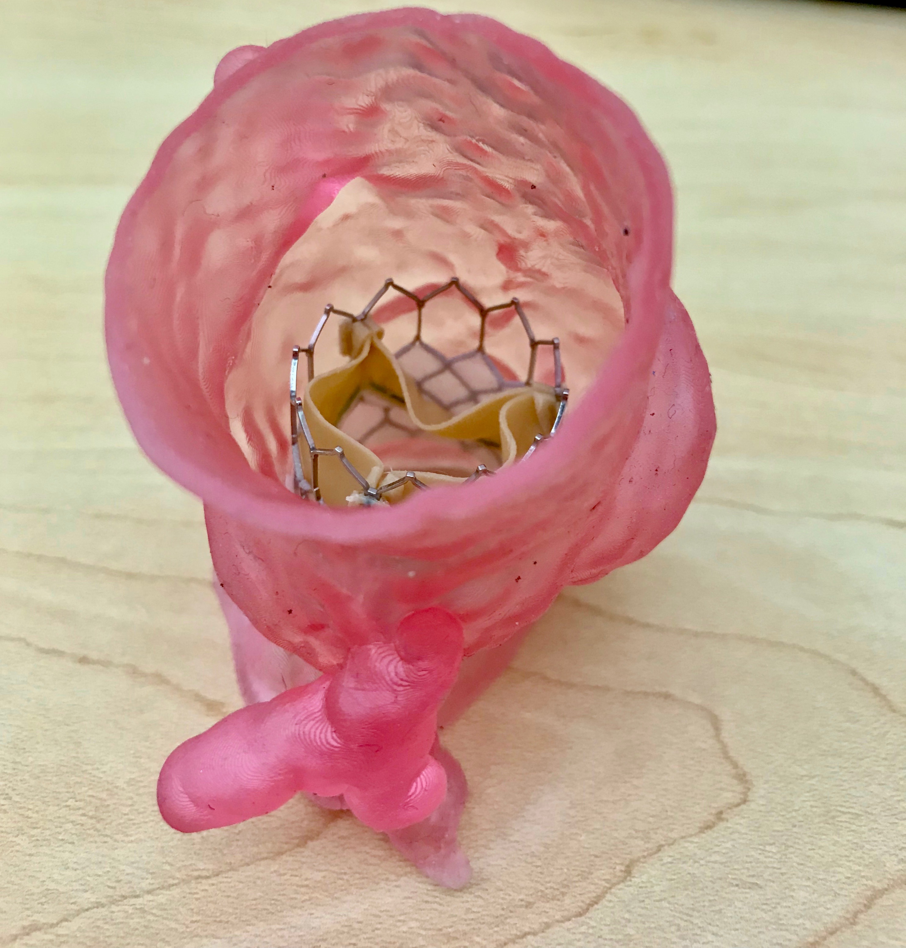 3D printed model of a patient's aortic valve with a transcatheter aortic valve replacement (TAVR) bioprosthetic placed into the 3D printed model for procedural planning purposes. Photo via VA Puget Sound Health Care System.