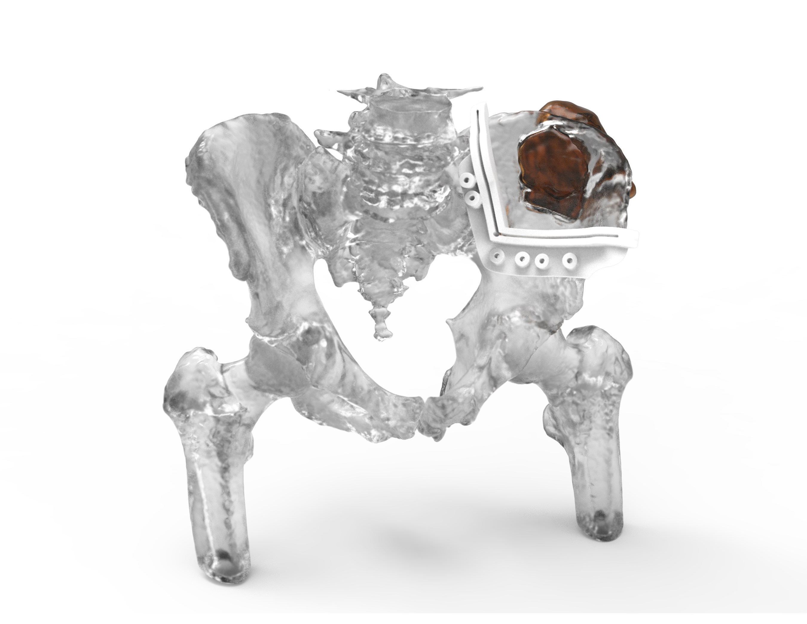 3D Systems’ FDA cleared VSP Orthopaedics solution enables surgeons to obtain a clear 3D visualization of a patient’s anatomy and develop a personalized surgical plan, prior to entering the operating room. Image via 3D Systems