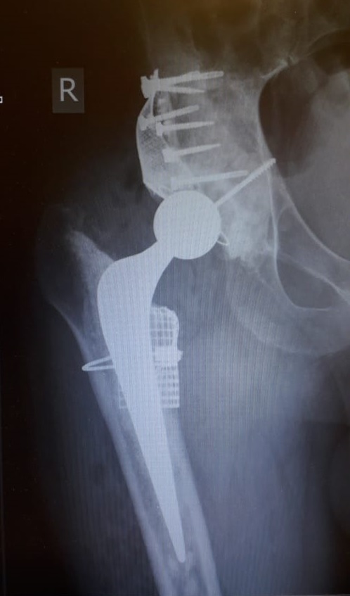 The result of surgery, showing the 3D printed implant. Image via LOGEEKs.