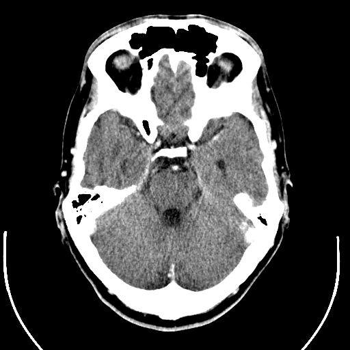 A CT brain scan of a cranium with TBI. Image via Qrons.