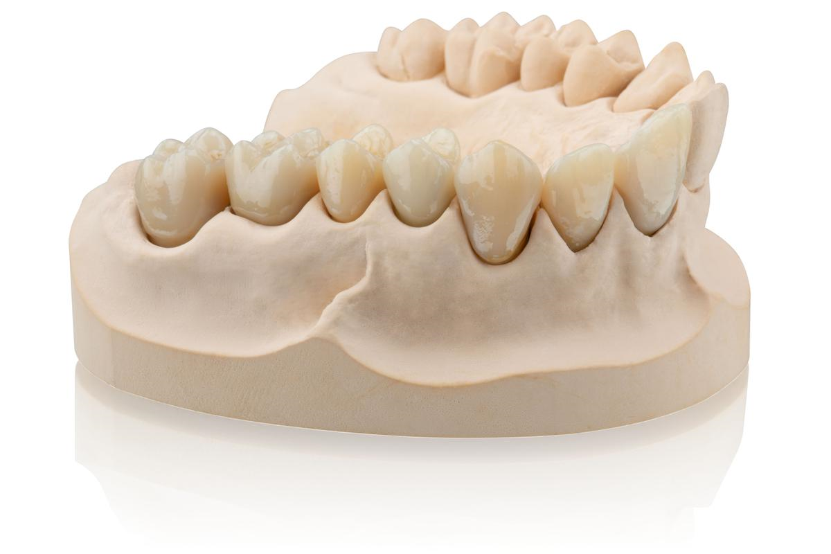 3D printed dental restorations. Image via Formlabs.