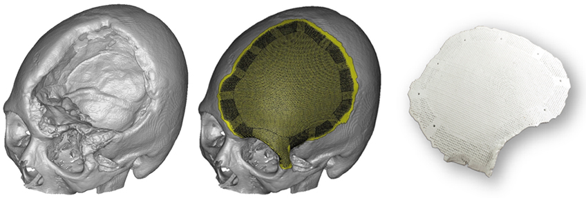 Ceramic cranial implant. Image via 3DCERAM-SINTO.