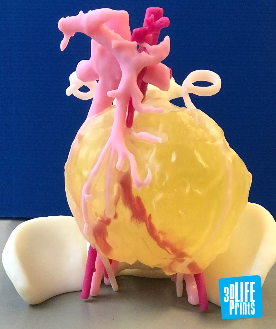 The 3D printed tumour model. Photo via 3D LifePrints.