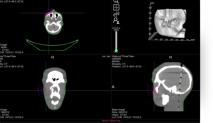 Adaptiiv's software creating a 3D model from a patient's CT scan data. Image via Adaptiiv.