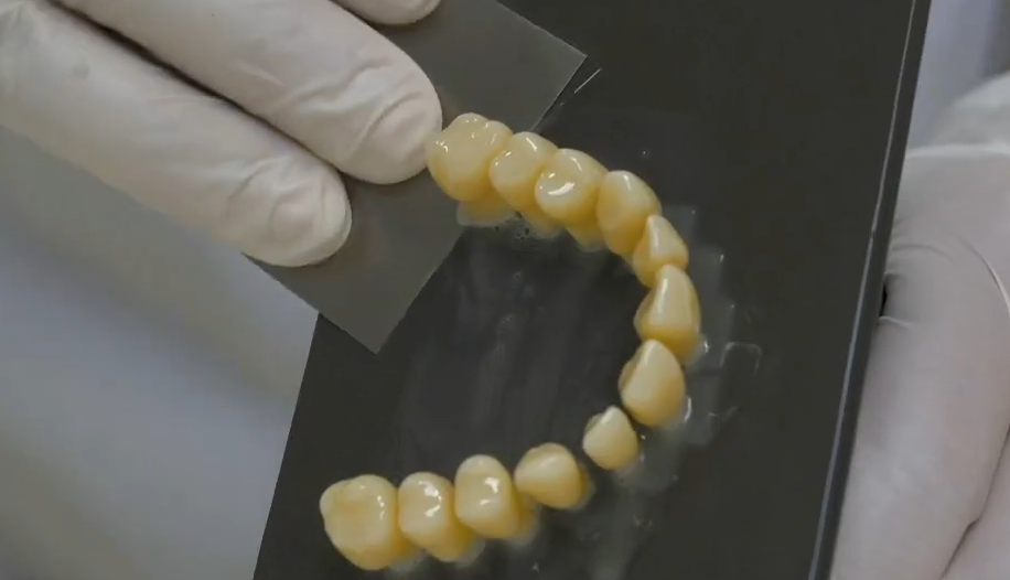 Restaurations dentaires imprimées avec la résine Saremco CROWNTEC.  Photo via Saremco.