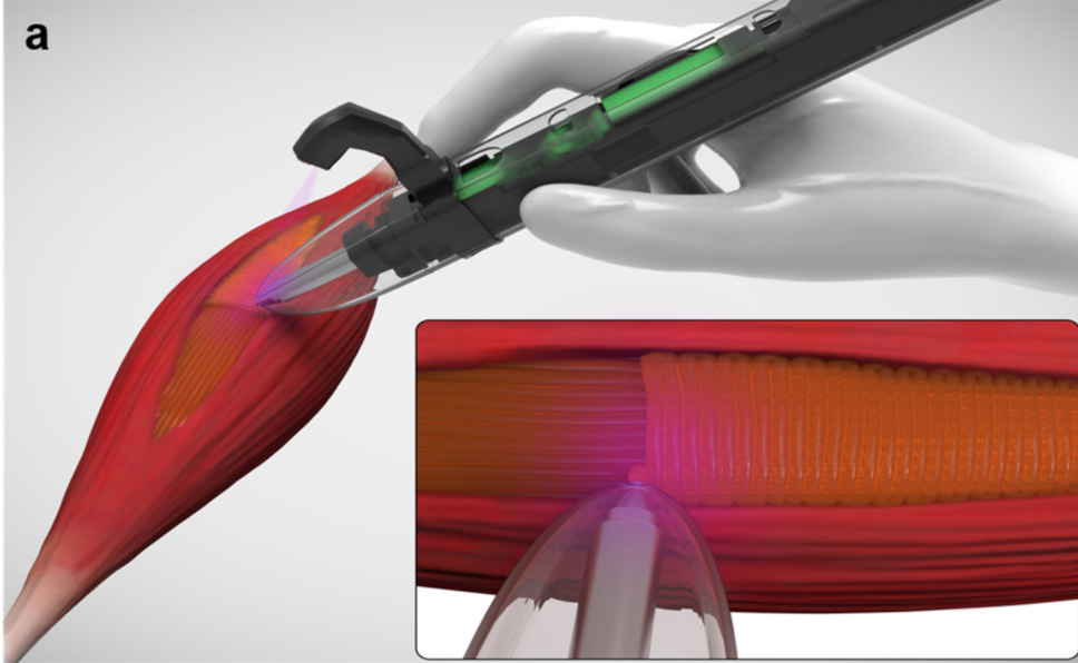 Handheld bioprinter repairing muscle tissue. Photo via ACS Publications.