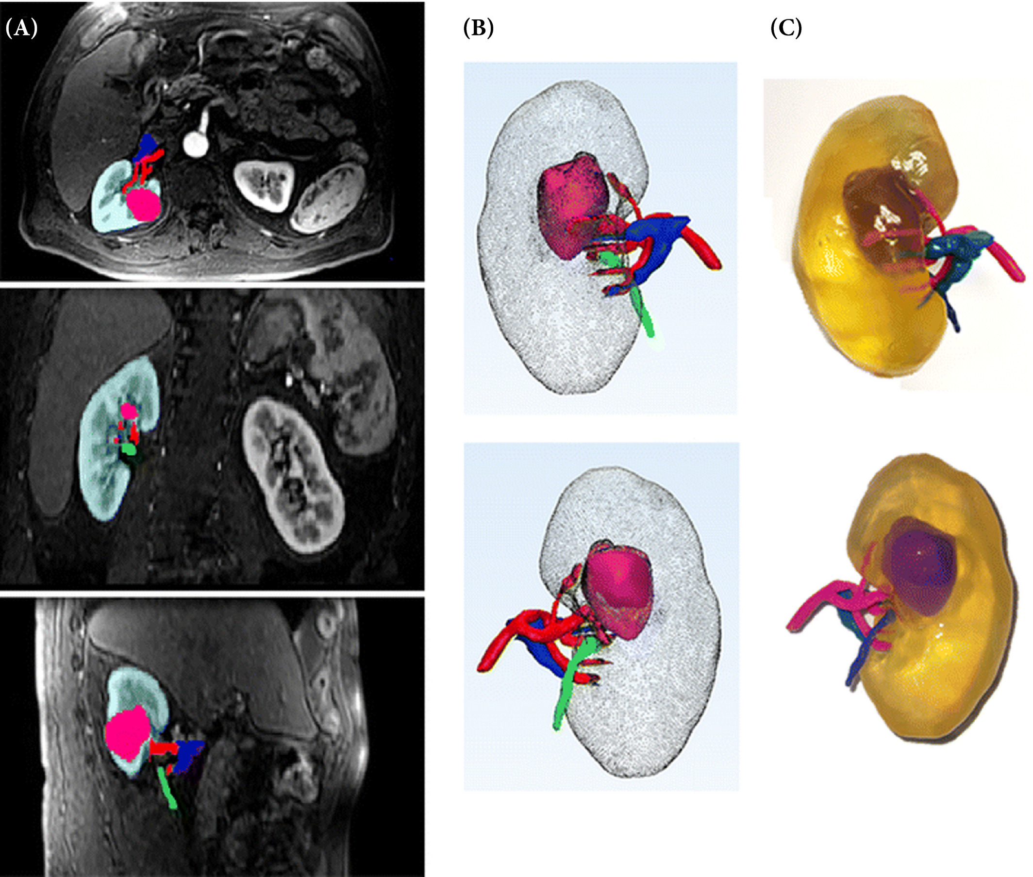 From MRI scan (A) to digital model (B) to physical 3D printed model (C). Image via Wake N et al.