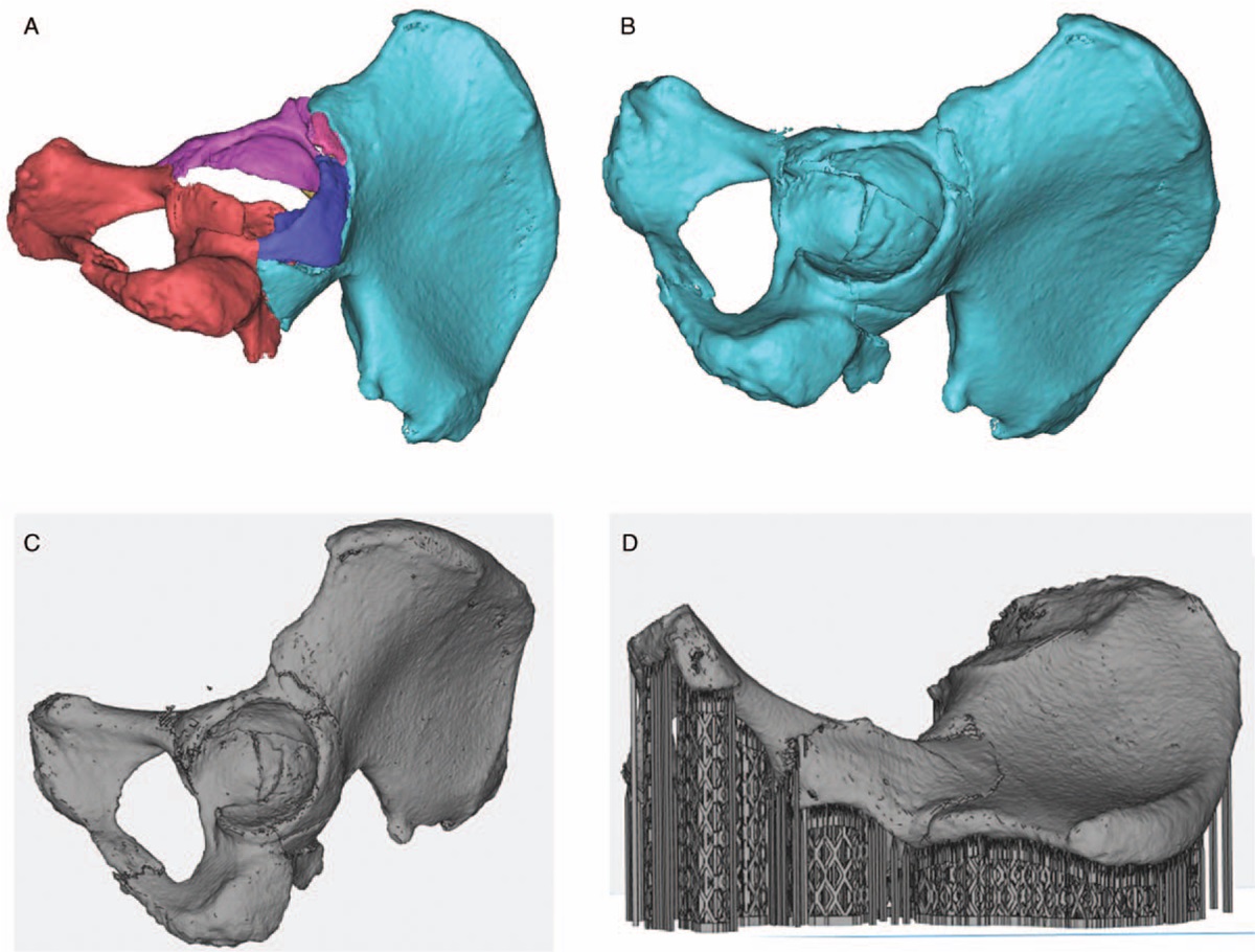 The 3D models of the fracture fragments. Image via Chinese Medical Journal.