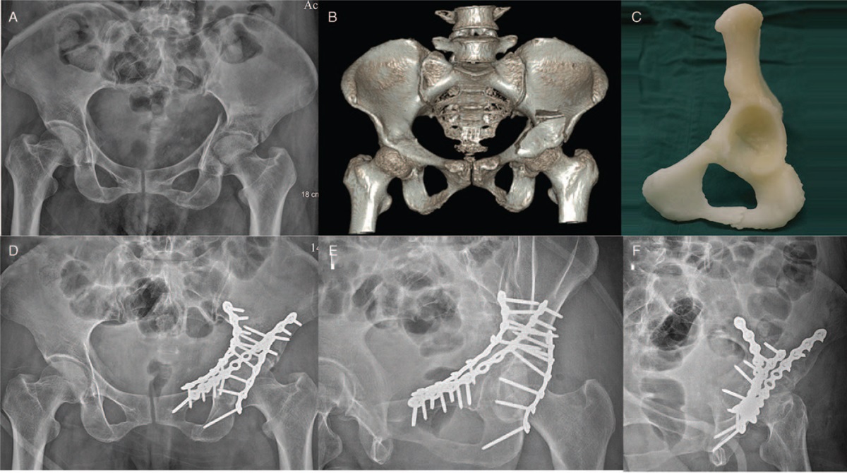 Images of one case in the 3D printing group. Image via Chinese Medical Journal.