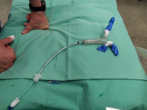 Lung operation on young girl in Israel aided by 3D printing - 3D ...