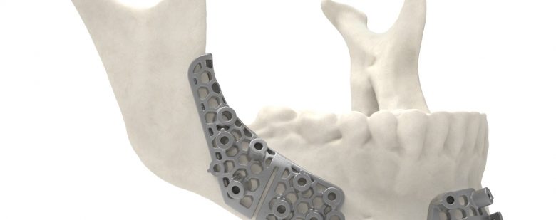 Titanium surgical guide. Image via 3D Systems.