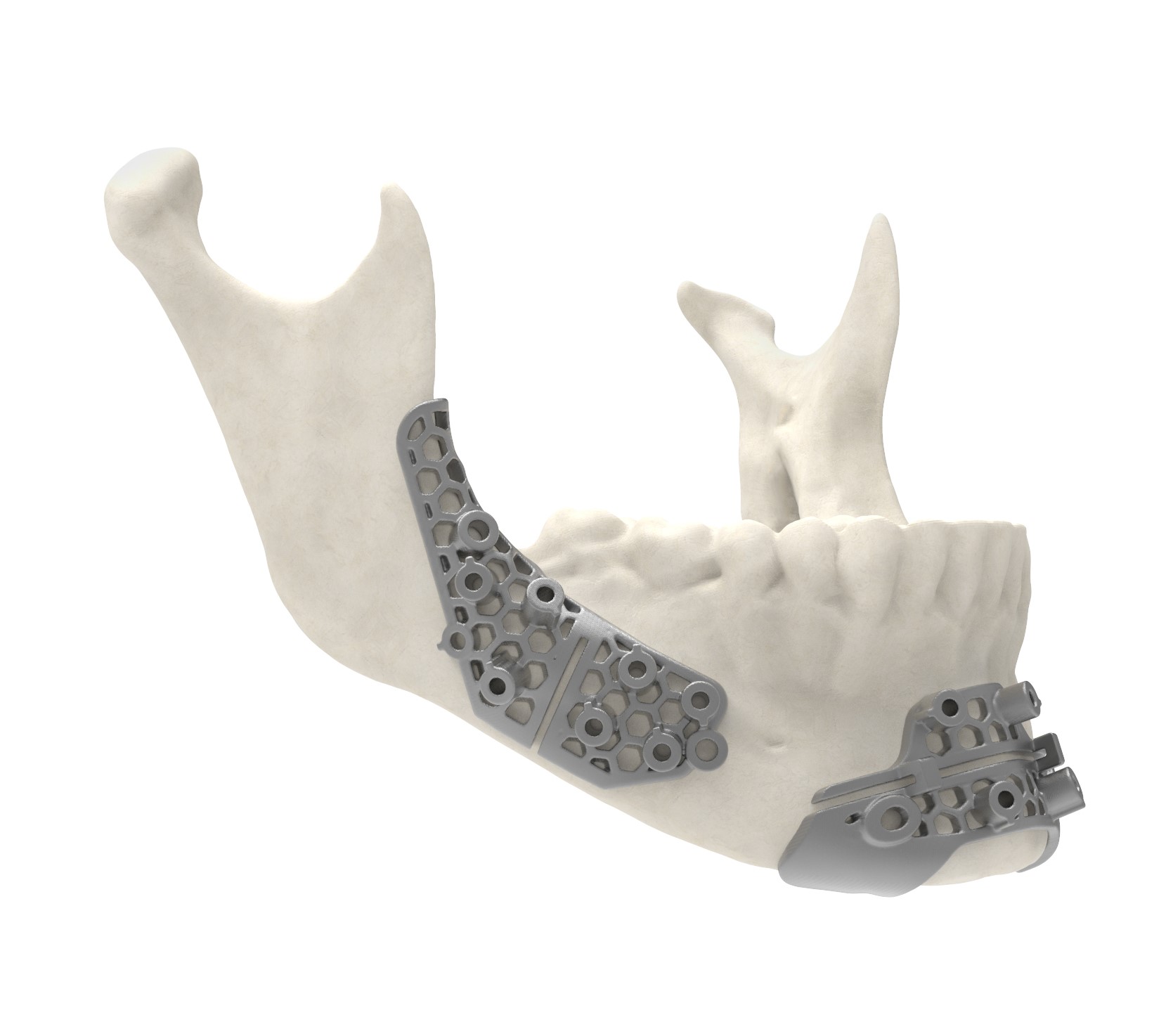 Titanium surgical guide. Image via 3D Systems.