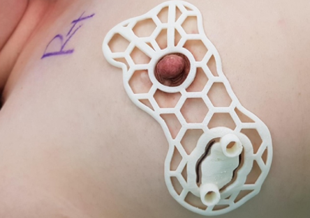 The scientists' 3D printed guide (pictured) proved capable of saving more breast tissue than conventional optimization methods. Photo via the Scientific Reports journal.