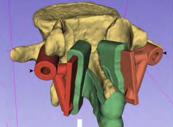 A 3D model of the doctors' 3D printed spinal surgery guides. 