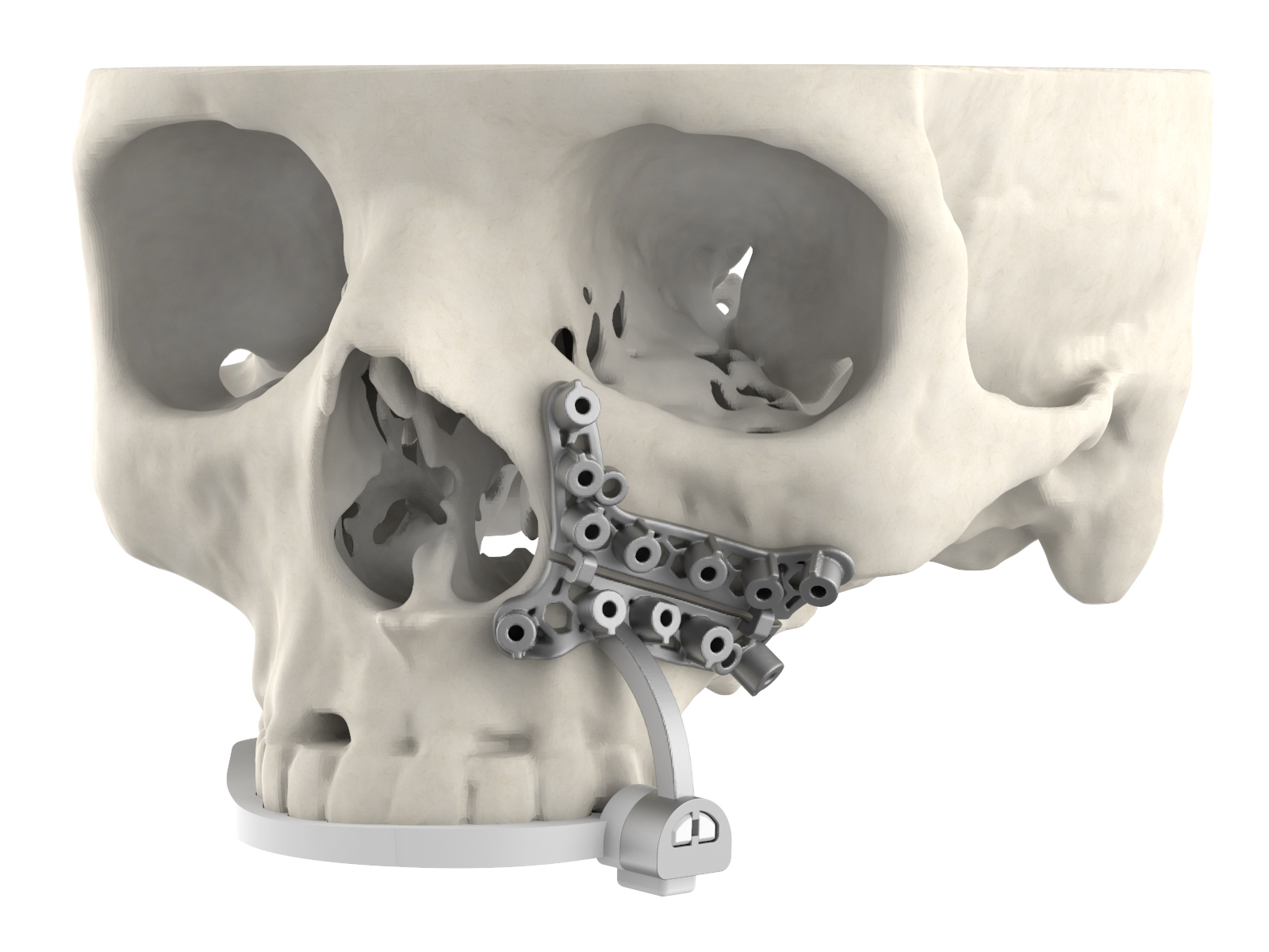 An image of 3D Systems' new surgical guide attached to a skull