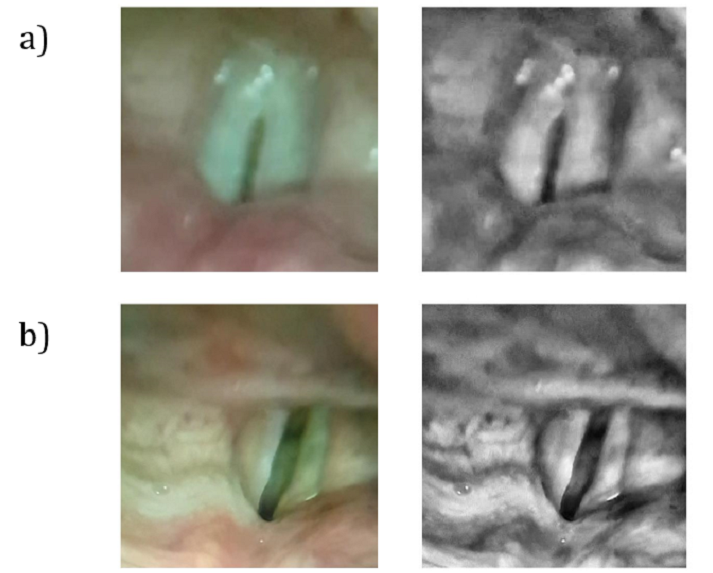 Images taken from inside the vocal cords of healthy (top) and unhealthy (bottom) vocal cords.