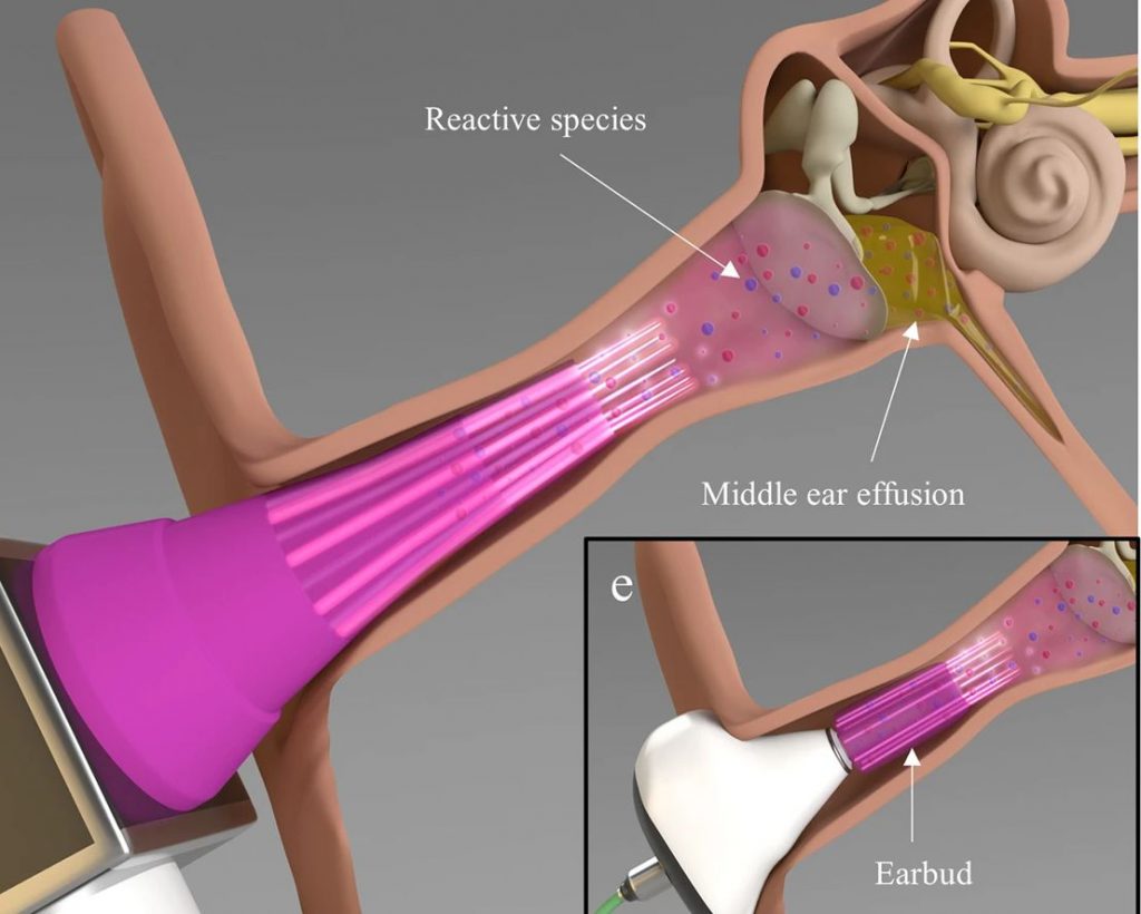 An illustration of the microplasma-integrated otoscope delivery platform inside an ear.