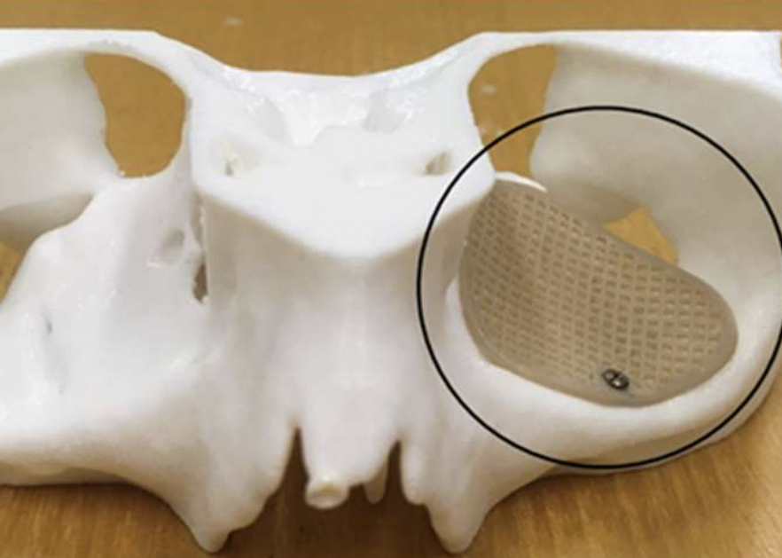 The researchers' 3D printed eye socket implant installed on a skull model.