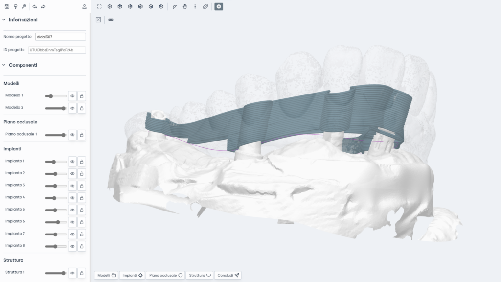 A CAD model of a Hi-Fiber 3D printable dental support. 