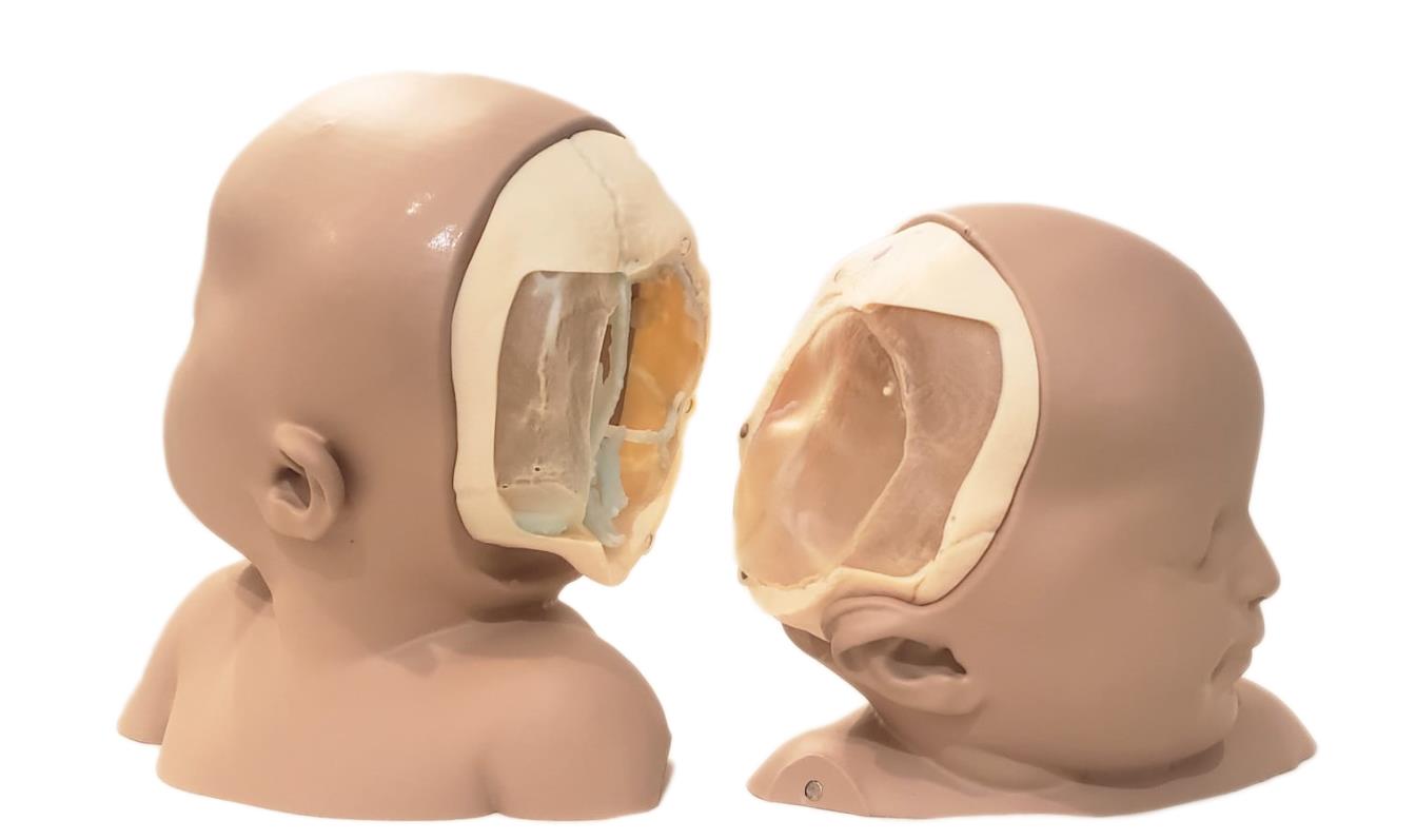 LMI が製作した結合双生児の 3Dプリントモデル。
後頭部が結合したモデルで、どの様な切り離しをするかをシミュレーションできる。