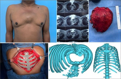 患者の胸部、腫瘍、インプラントされたチタン骨格の写真と、チタン骨格の 3Dモデル