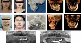 Titanium reconstruction of tumor-induced mandibular defects. Image via Nature.