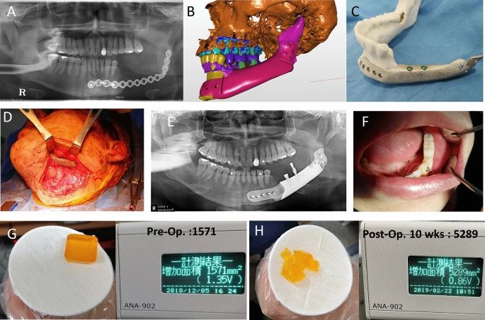Dental implant on a titanium mandible. Image via Nature.