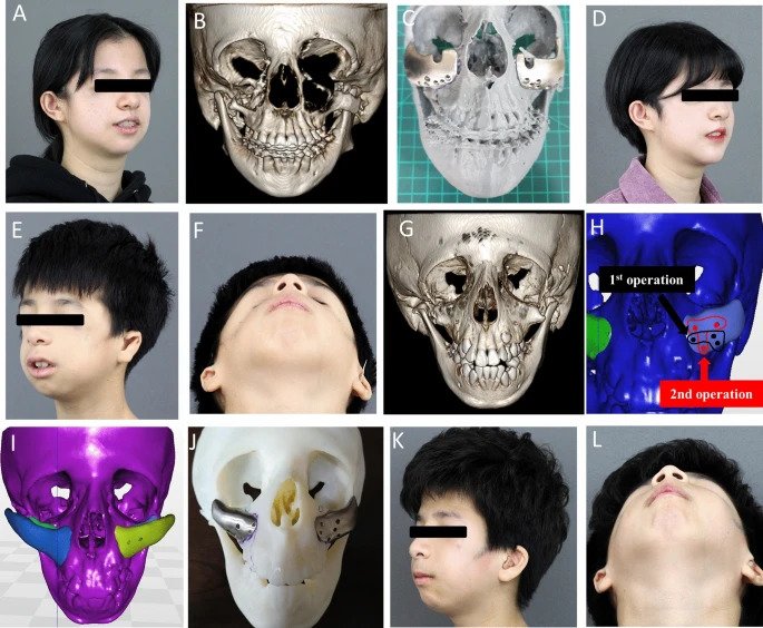 Photographs of patients with Treacher-Collins syndrome. Image via Nature.