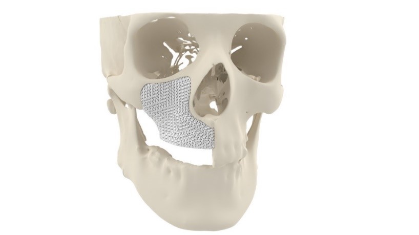 Greffe d'os facial imprimée en 3D MyBone de Cerhum.  Image via Cerhum.